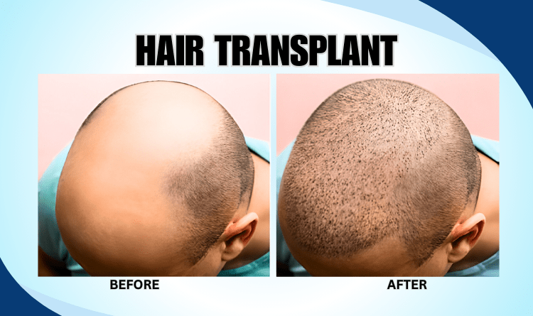 زراعة الشعر